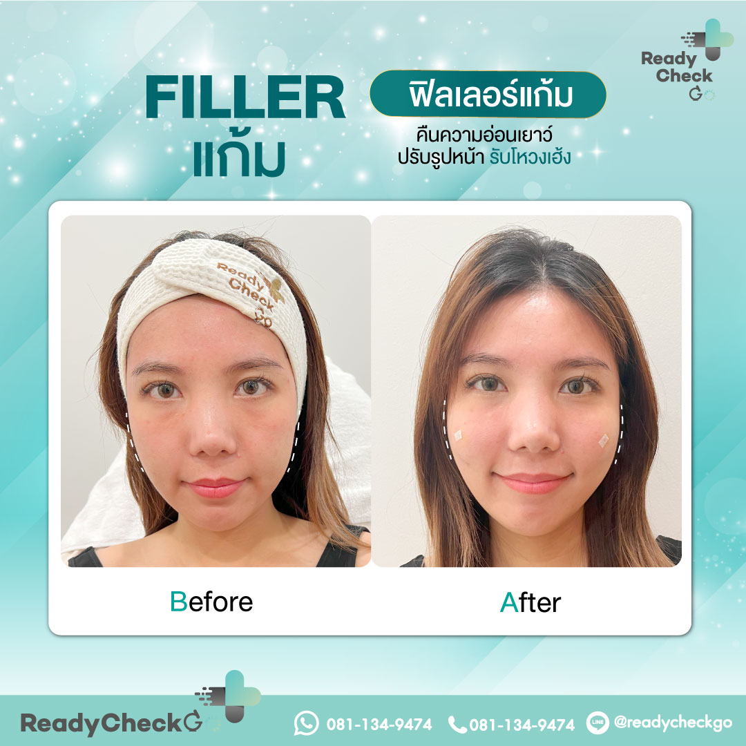 211.3